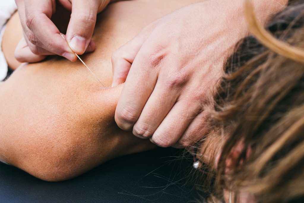 Things to Know About Dry Needling shutterstock 317136938 dry needling