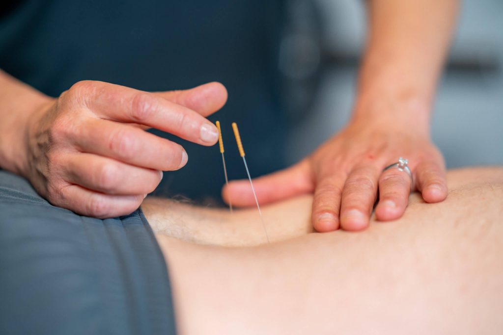 dry needling in apache junction, az