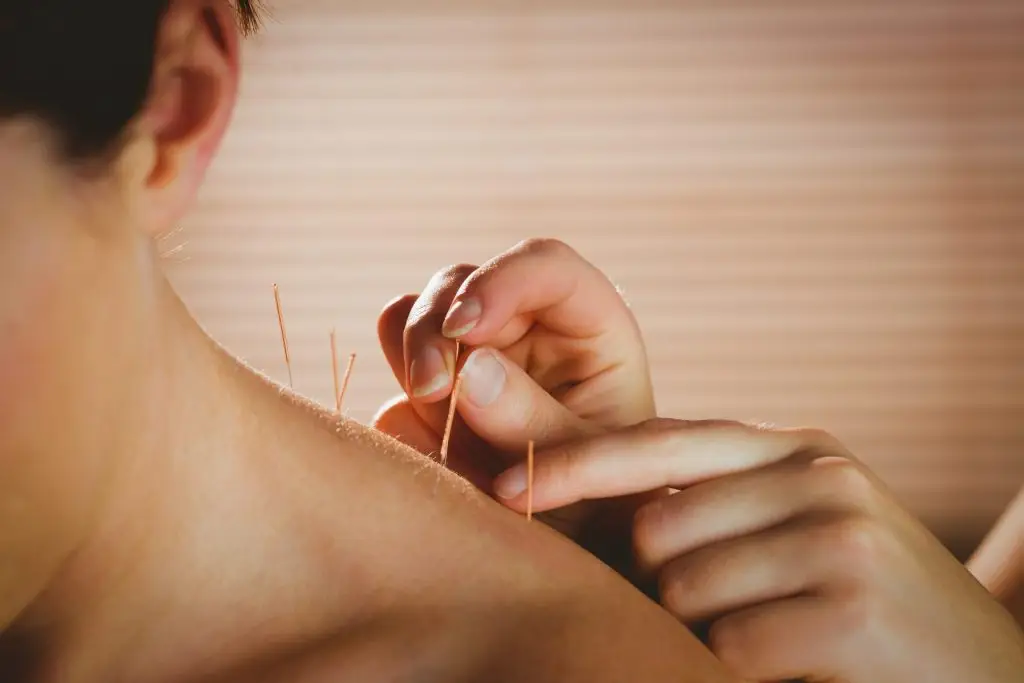 dry needling vs. acupuncture: differences and benefits